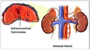 adrenal cancer