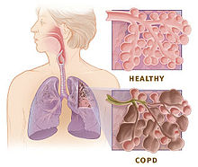 copd
