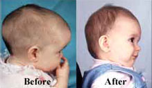 craniosynostosis