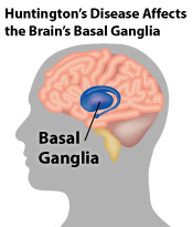 huntington disease