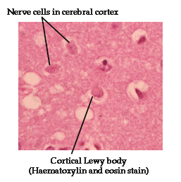 lewy body dementia