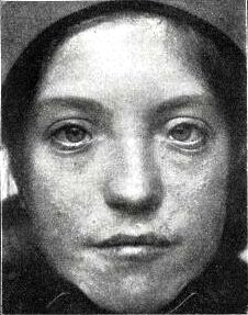 loeys dietz syndrome