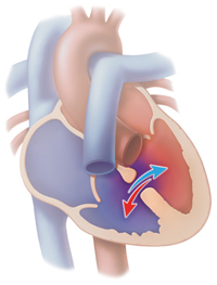 eisenmenger syndrome