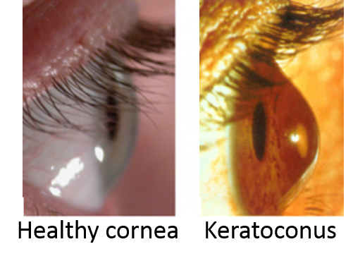 keratoconus 1