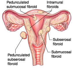 Types-of-Uterine-Fibroids