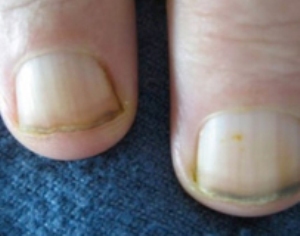 pale nail