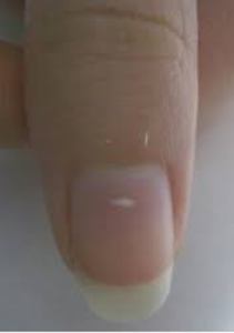 white spot nail