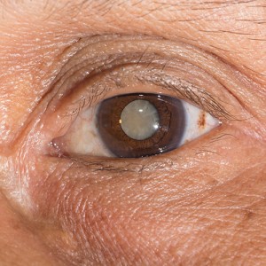 cataract