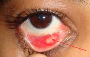 chalazion