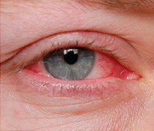 irritated red eye