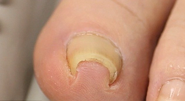 ingrown toe nails1