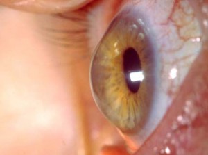 keratoconus