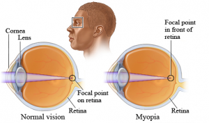 near sighted