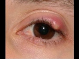 stye