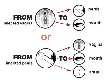 gonorrhea