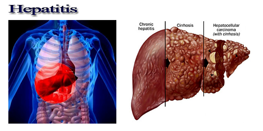 Hepatitis Causes, Symptoms | Homeopathic Treatment