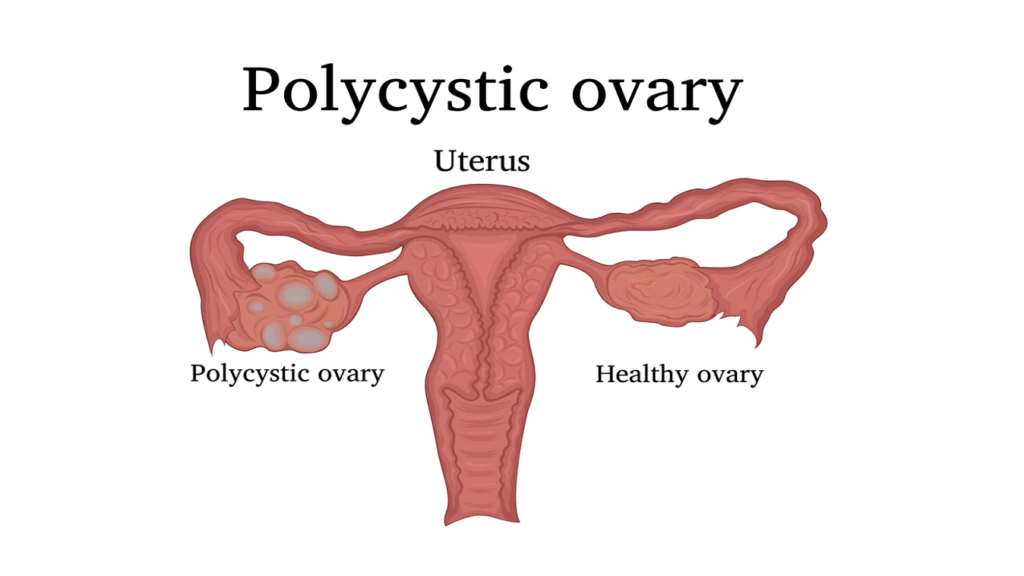 pcod-pcos-dr-thind-homeopathy