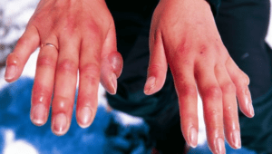 frostbite prevention