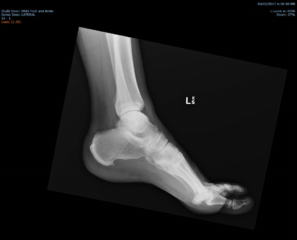 Calcaneal hotsell spur homeopathy