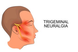 trigeminal neuralgia