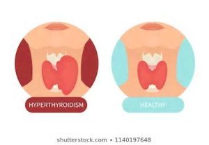 thyroid and sweating