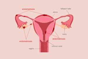 Endometriosis facts