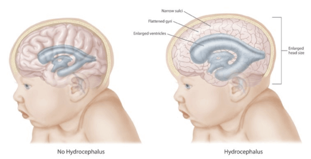 learning disability hydrocepahlus