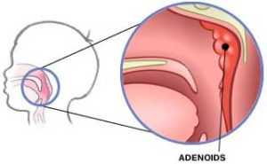 enlarged adenoids