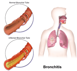 Bronchitis with Homeopathy