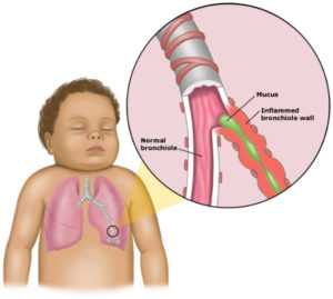 Bronchitis with Homeopathy