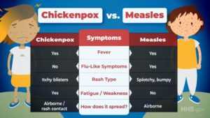 chickenpox vs measles
