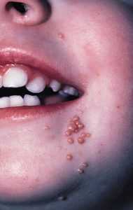 molluscum contagiosum prevention