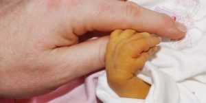 neonatal jaundice