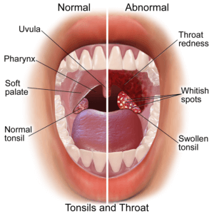 Tonsillitis