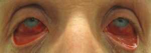 acute haemorrhagic conjunctivitis