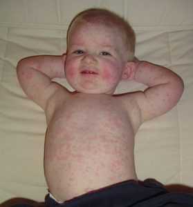 parvovirus