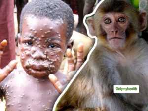 monkeypox virus