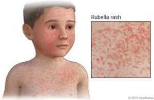 Rubella | Signs & Symptoms | Prevention | Dr. Thind's Homeopathy