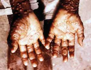 smallpox