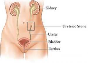 ureter stone
