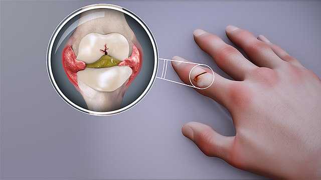 rheumatoid arthritis - effects on hands joints