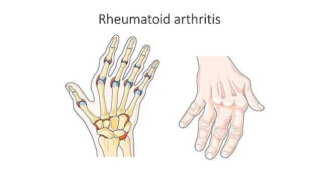 rheumatoid arthritis and it's effect on different body parts