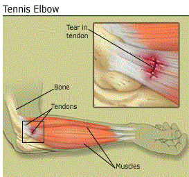 exercises for tennis elbow