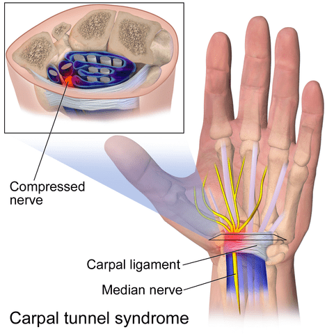 Lifestyle Measures for Carpal Tunnel Syndrome
