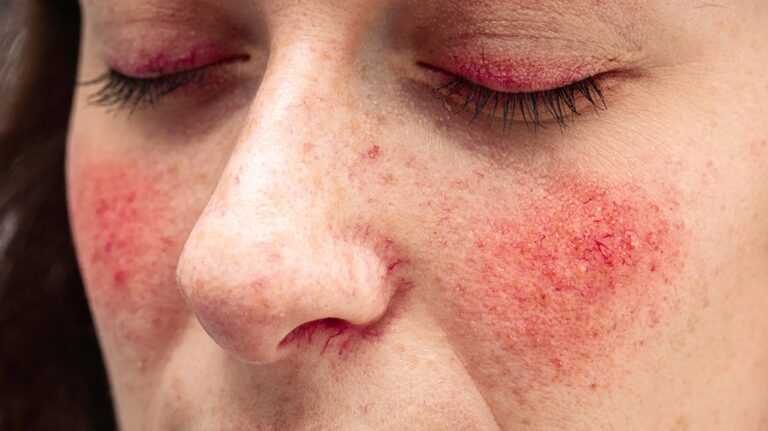 Acne Rosacea Causes And Treatment Dr Thind Homeopathy