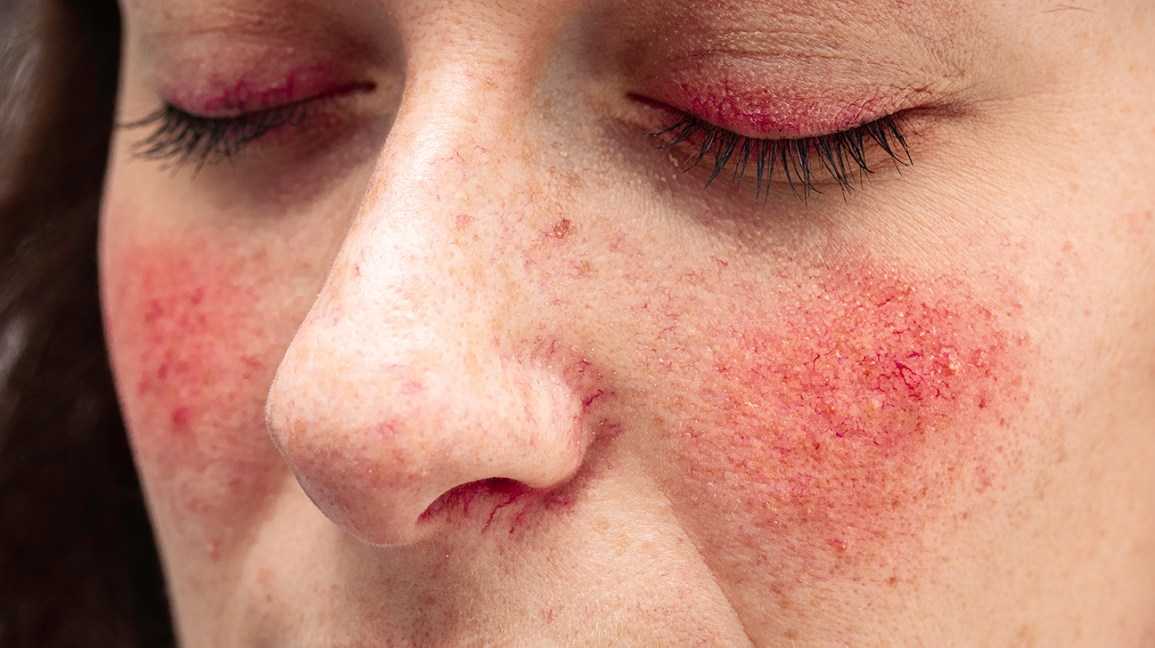 Acne Rosacea