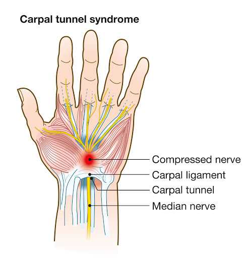 Homeopathy for Carpal Tunnel Syndrome