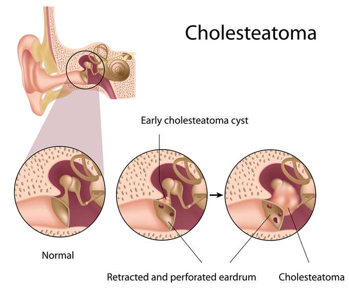 cholesteatoma