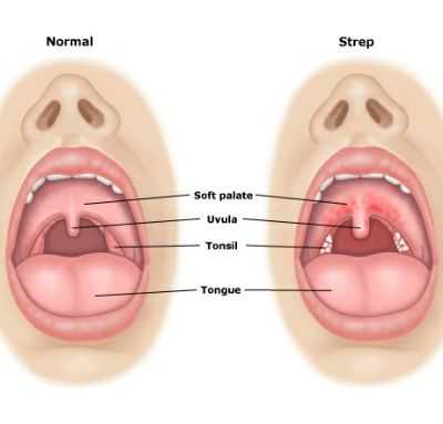 strep throat