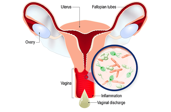 remedies for vaginal yeast infection